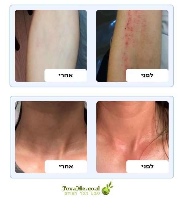 ג'ל רחצה טיפולי להקלה על עור יבש אדמומי ומגורה CALM קמדיס Kamedis